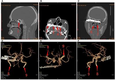 Anesthesia strategies for elderly patients with craniocerebral injury due to foreign-body penetration in the plateau region: a case report